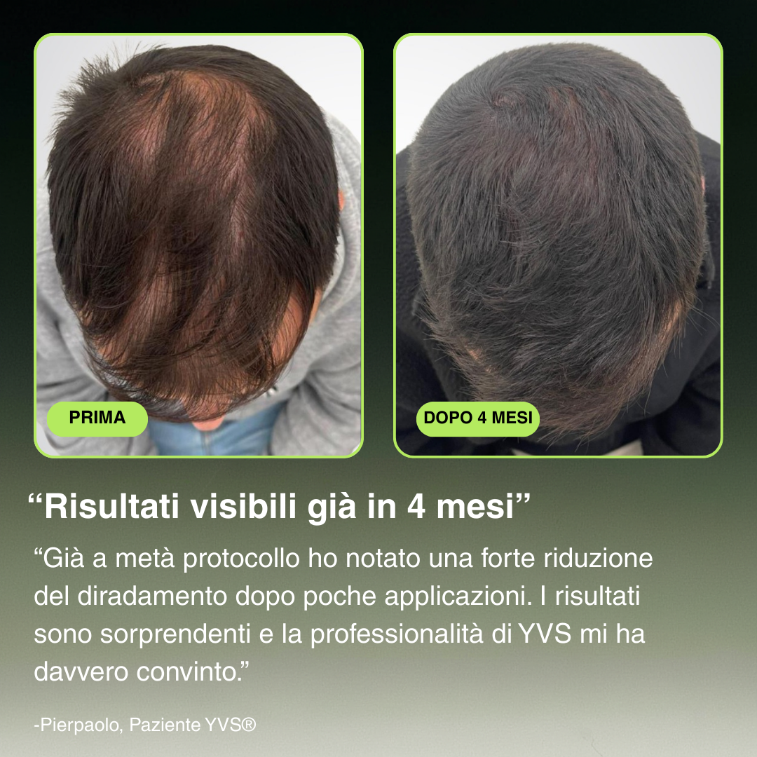 YVS - Sistema di Microinfusione Avanzata per la ricrescita dei capelli