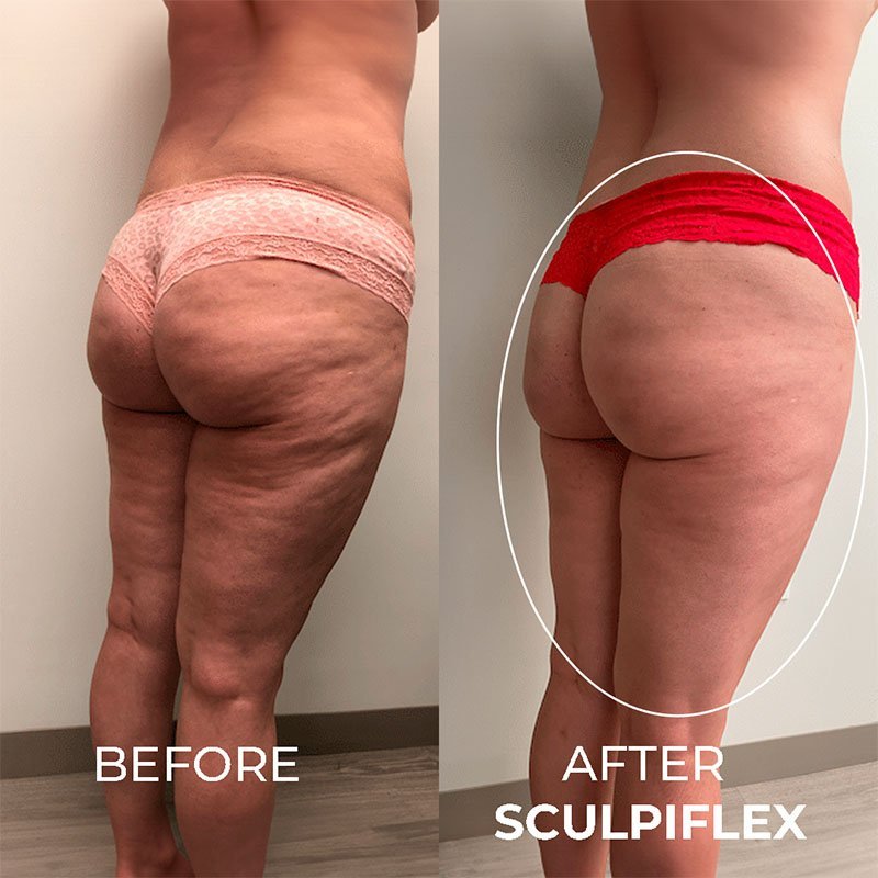 Sculpiflex Body Sculpting Device