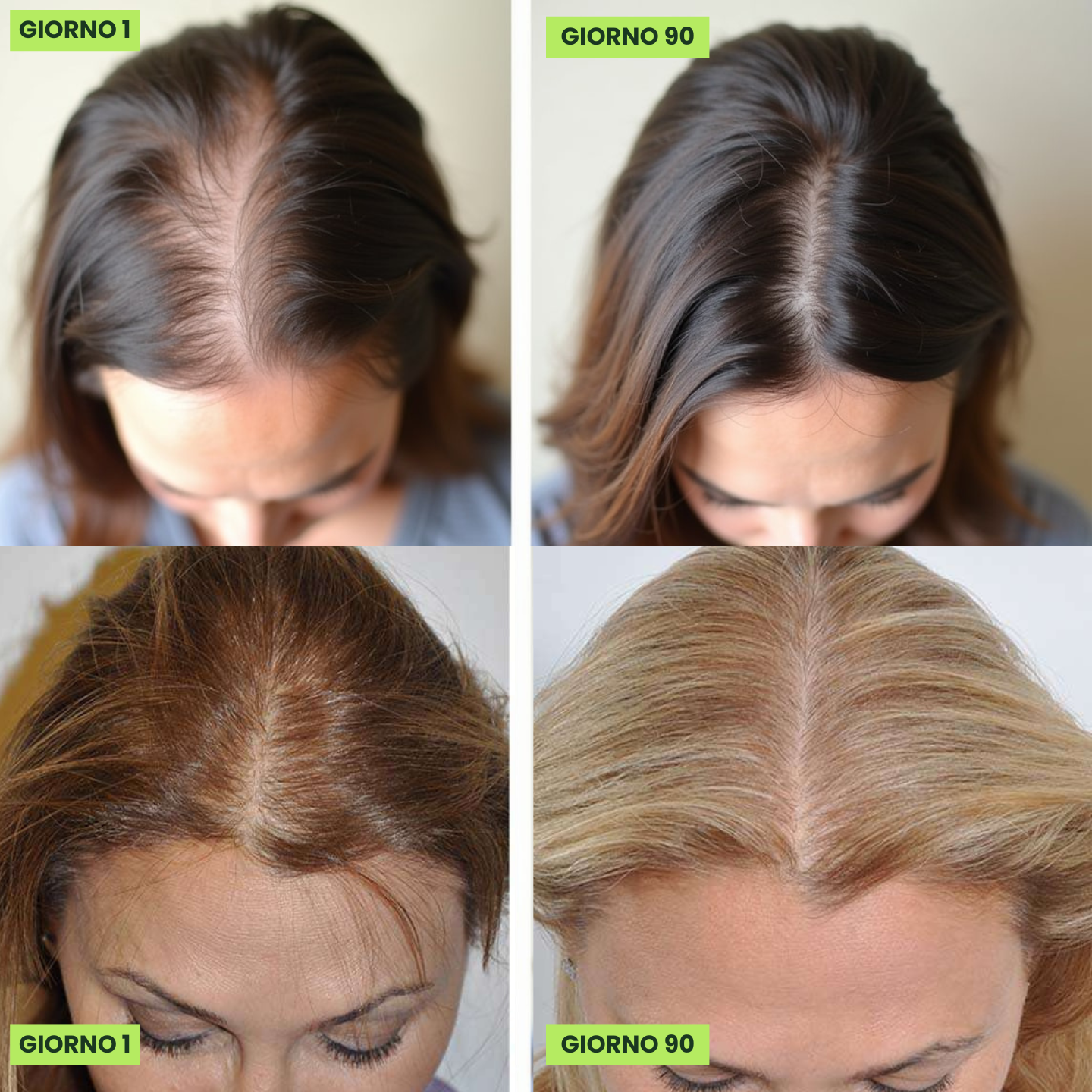 YVS - Fortgeschrittenes Mikrodosierungssystem zur Haarwiederherstellung