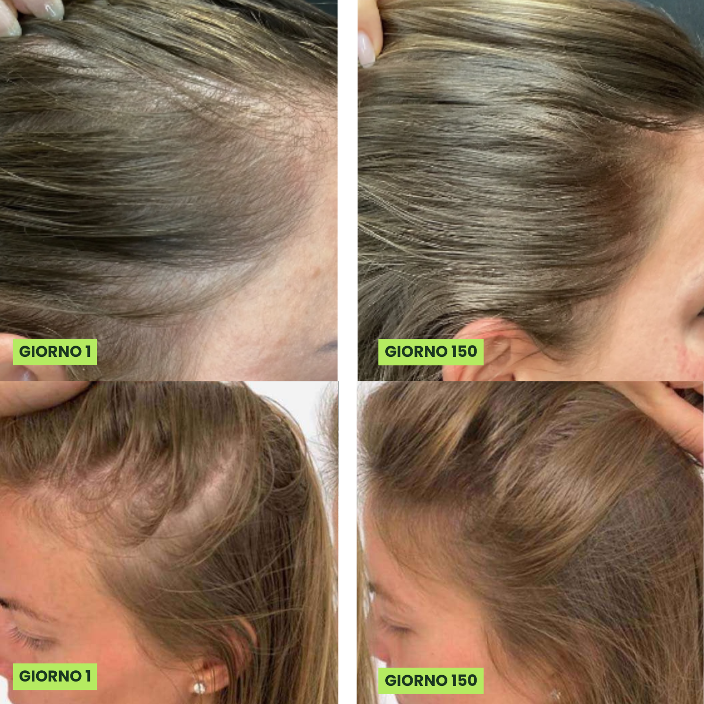 YVS - Fortgeschrittenes Mikrodosierungssystem zur Haarwiederherstellung